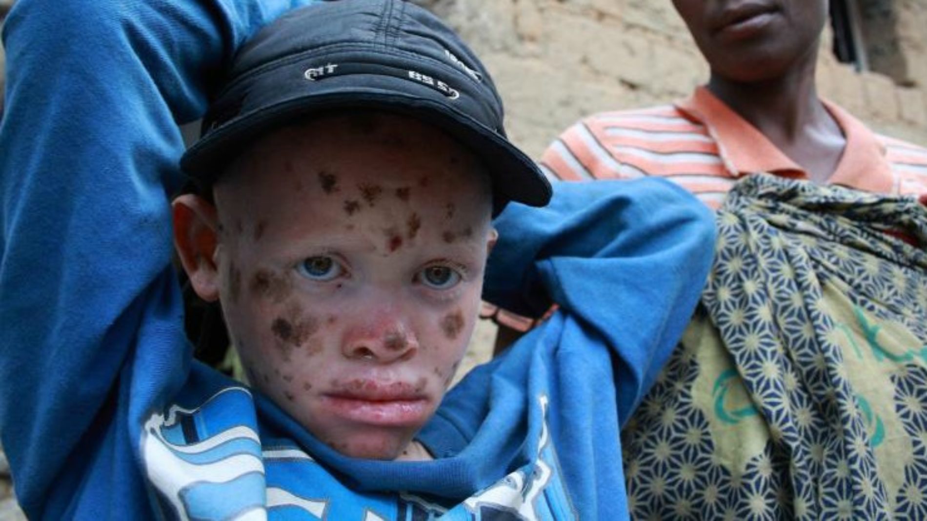 Burundi : 24 albinos tués en huit mois