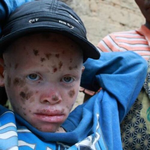 Burundi : 24 albinos tués en huit mois