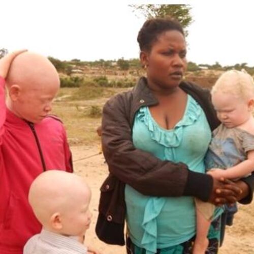 IMAGE de la semaine : les réfugiés burundais  albinos demandent  une assistance particulière