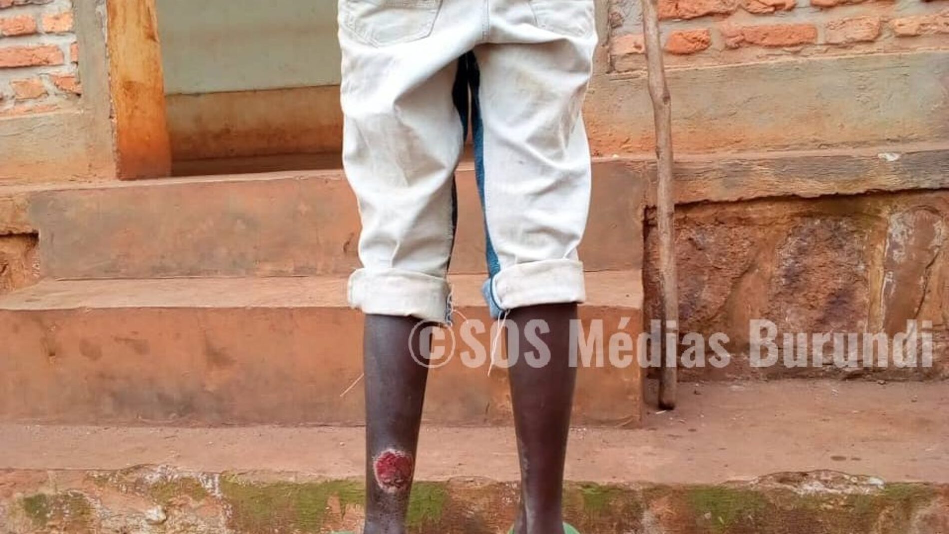 La maladie d&rsquo;Ulcère de Buruli diagnostiquée à Butihinda