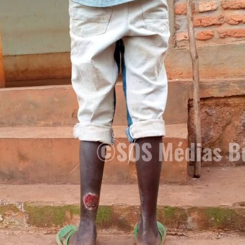 La maladie d&rsquo;Ulcère de Buruli diagnostiquée à Butihinda