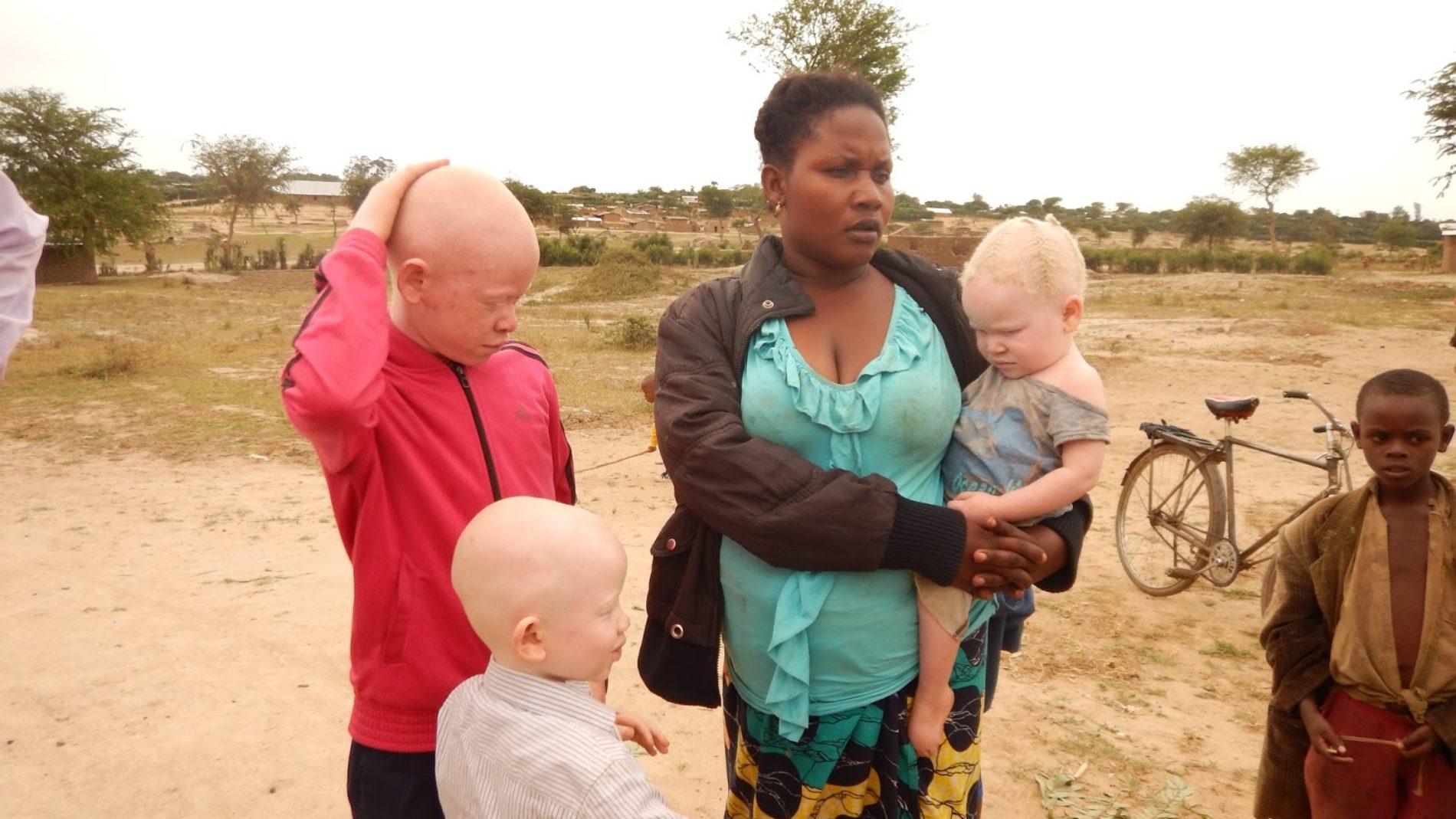 Nakivale-Ouganda : les réfugiés burundais albinos demandent une assistance particulière