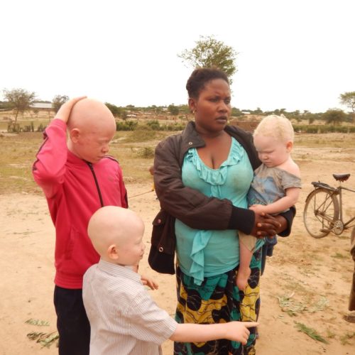 Nakivale-Ouganda : les réfugiés burundais albinos demandent une assistance particulière