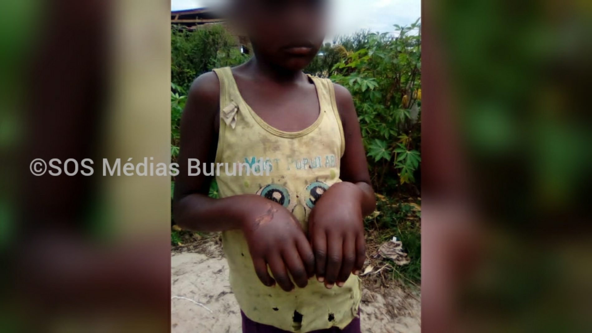 Gihanga : un chef de colline et membre de la ligue des Imbonerakure brûle une fillette, des habitants exigent qu&rsquo;il soit puni