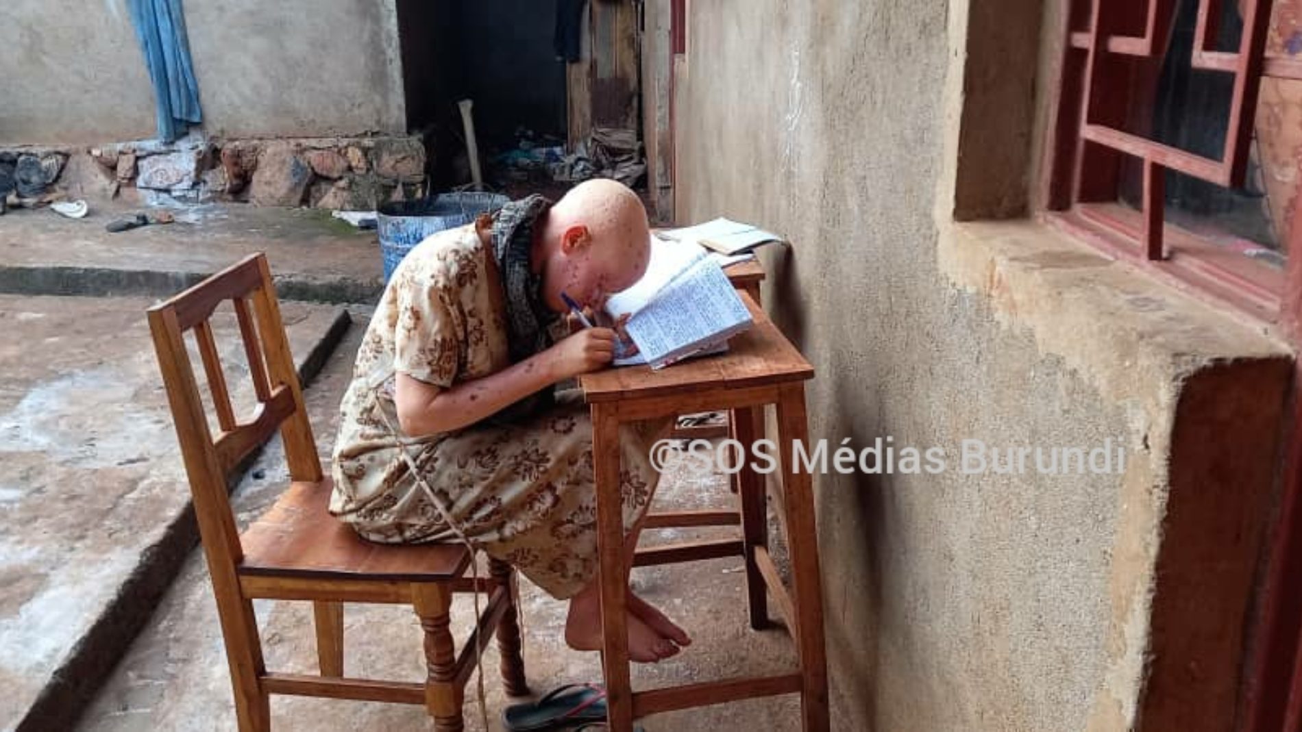 Gitega : l&rsquo;association des albinos du Burundi sonne l&rsquo;alerte