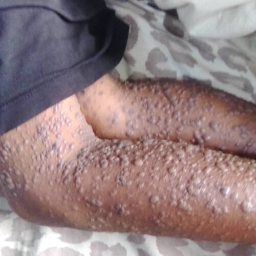 Mugamba: ugonjwa wa ajabu tayari umeua mtu mmoja