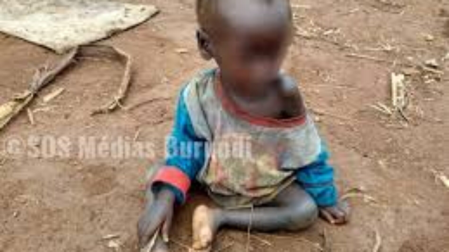 Kayanza: Kwashiorcor inatishia zaidi ya 50% ya watoto