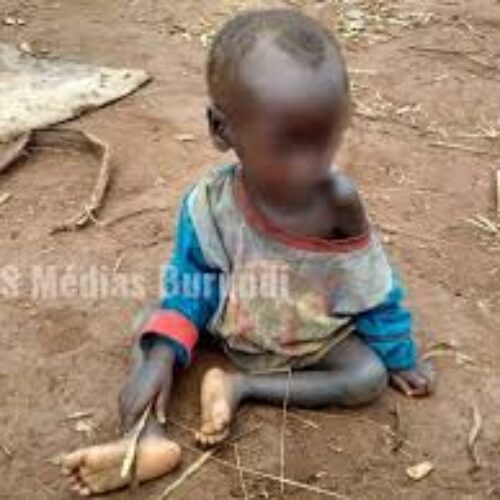 Kayanza: Kwashiorcor inatishia zaidi ya 50% ya watoto
