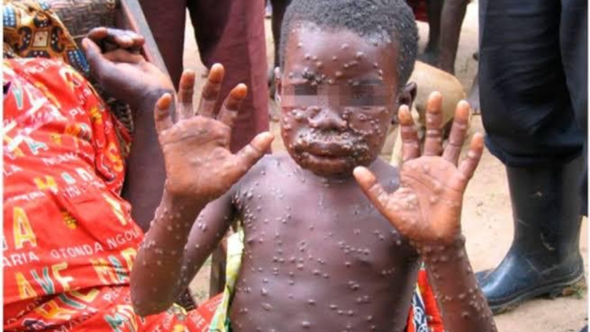 DRC : over 15 thousand cases of monkeypox