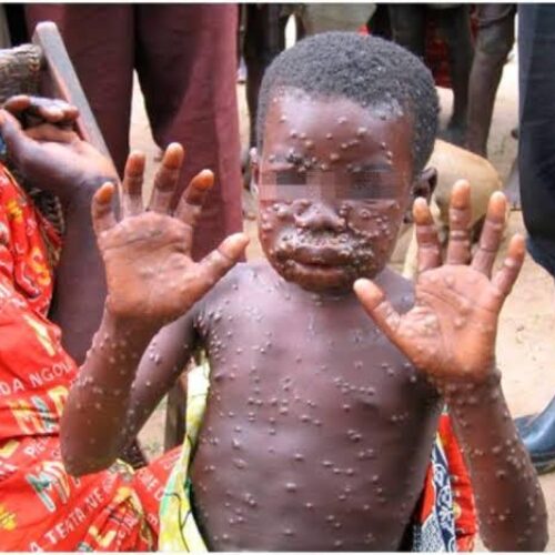 DRC : over 15 thousand cases of monkeypox