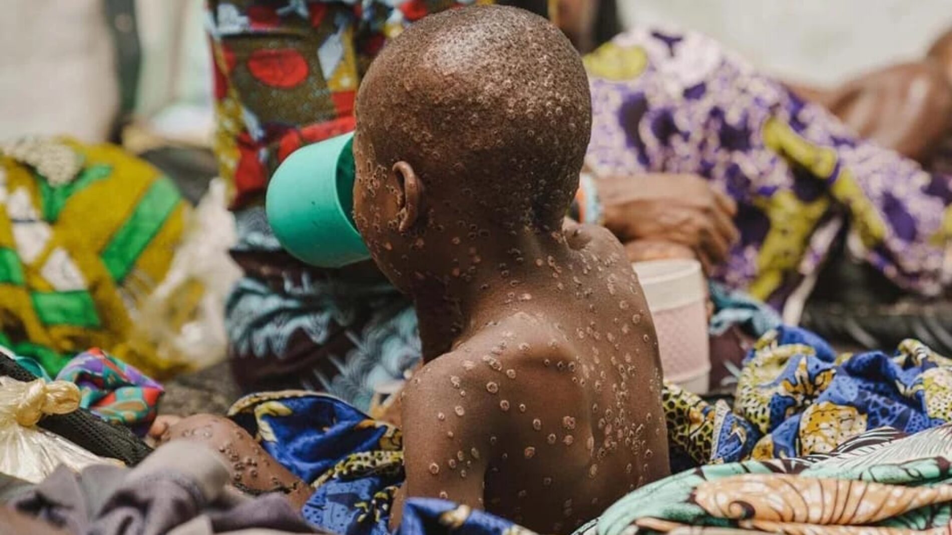 RDC : le gouvernement engagé dans la lutte contre le virus de Monkeypox qui a déjà causé la mort de 548 personnes