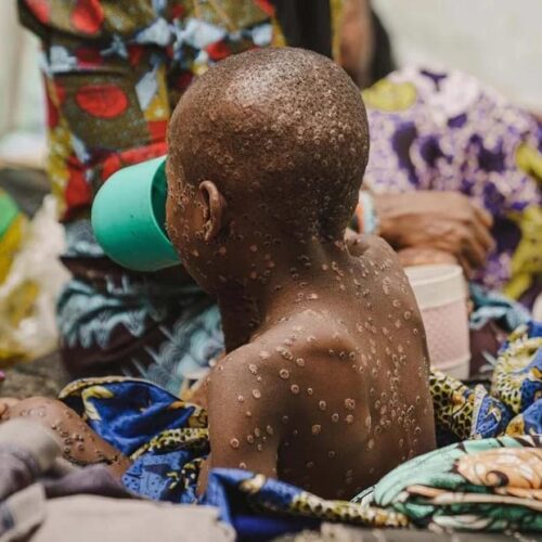 DRC: Serikali ilijitolea kupambana na virusi vya Monkeypox ambavyo tayari vimesababisha vifo vya watu 548.