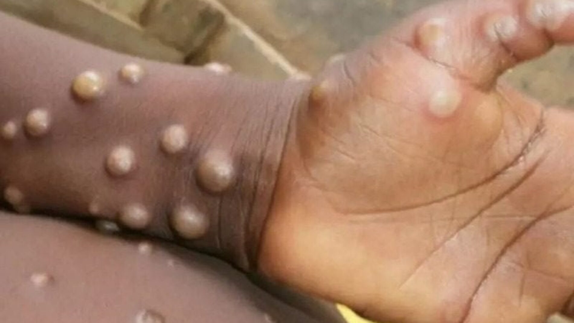 Burundi : les personnes atteintes de la variole du singe vont être soignées gratuitement