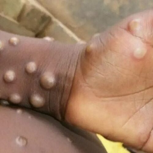 Burundi: watu wanaougua tumbili watapokea matibabu bila malipo