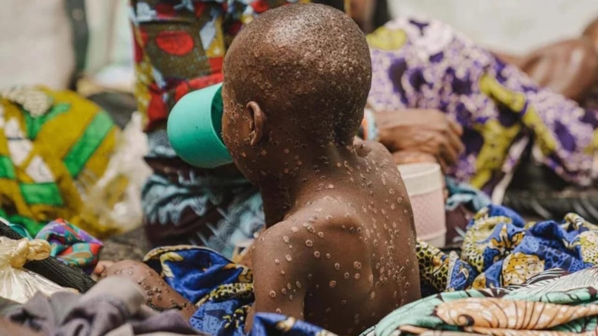 Burundi : fight against the Mpox pandemic, city dwellers seem to trivialize the disease