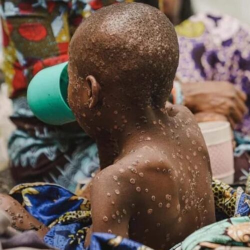 Burundi : fight against the Mpox pandemic, city dwellers seem to trivialize the disease