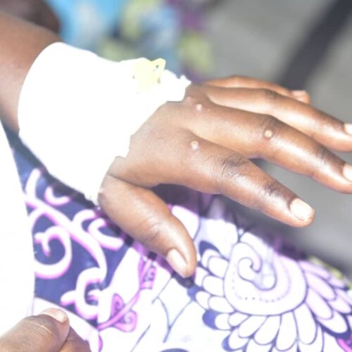 Gitega: Kesi mbili za Mpox zimeripotiwa katika gereza lenye watu wengi huku idadi ya wagonjwa ikiongezeka katika mkoa huo