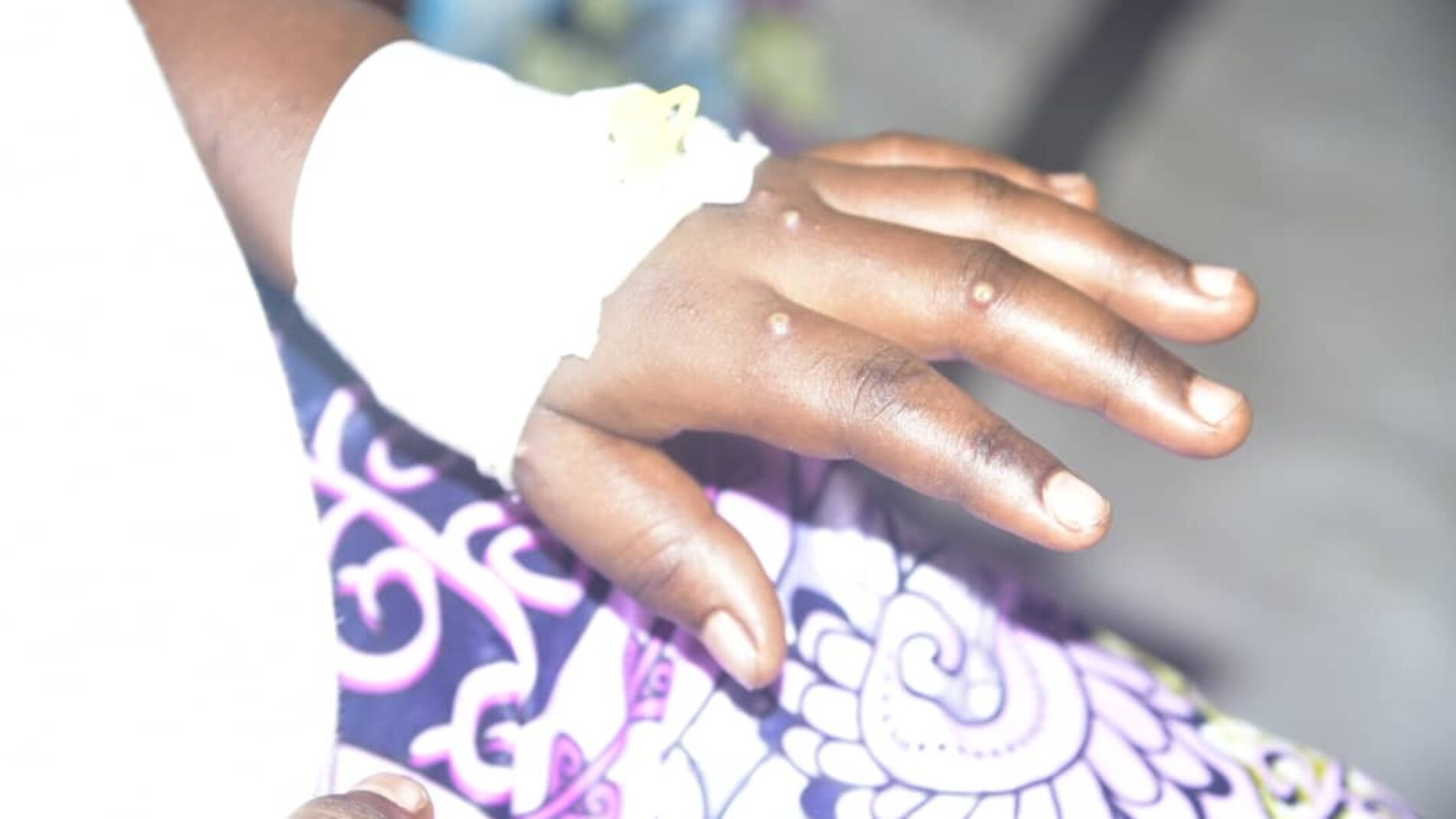 Gitega : two Mpox cases reported at the most populated prison whereas the number of patients increases in the province