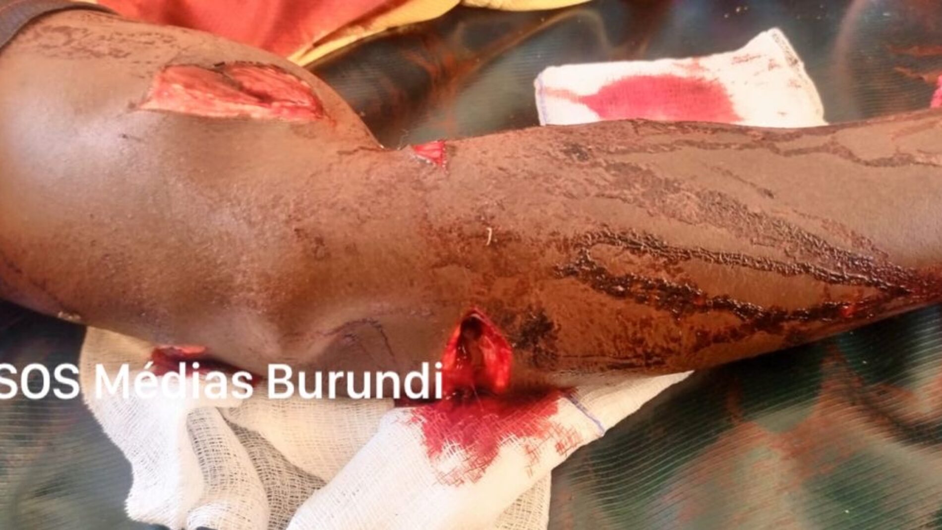 Kakuma (Kenya) : a Burundian refugee attacked