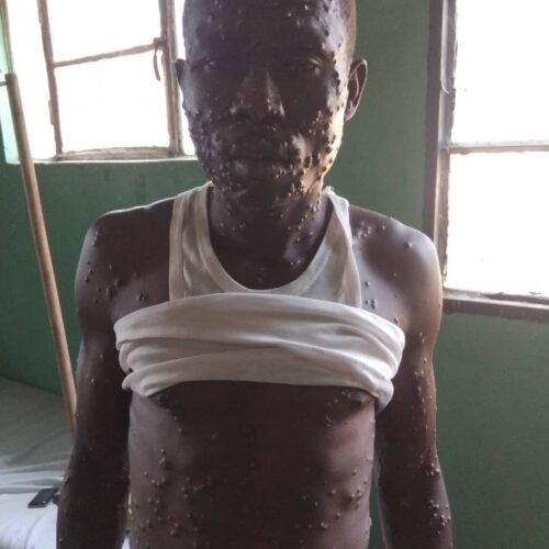 Mpanda: Ugonjwa usiojulikana waripotiwa kilimani Gihungwe