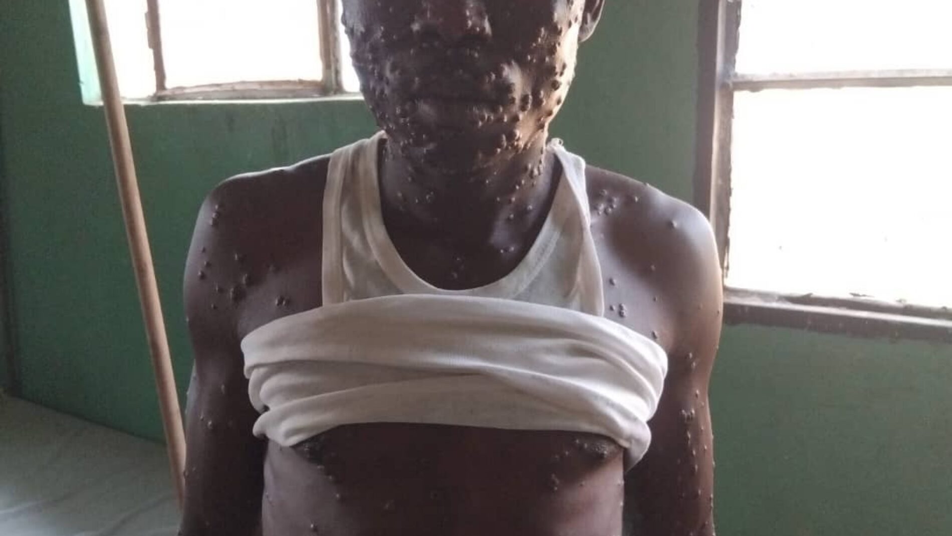 Mpanda : an unknown disease reported in Gihungwe village